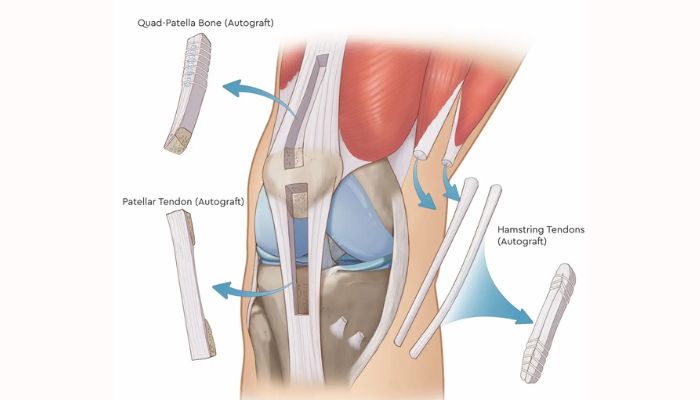 Allografts