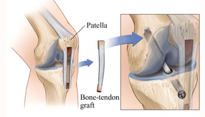 Bone-Patellar Tendon-Bone (BPTB) Autograft