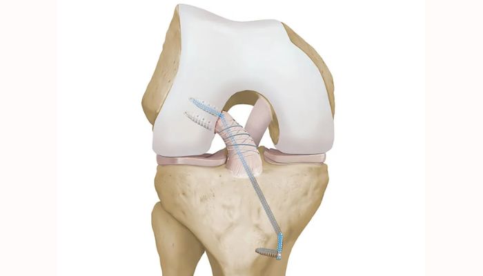 Synthetic Grafts