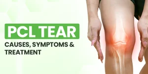 Read more about the article PCL Tear: Causes, Symptoms, & Treatment